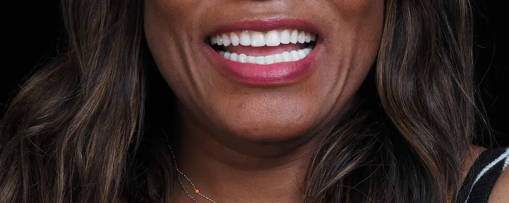 Cas 01, le sourire obtenu après traitement